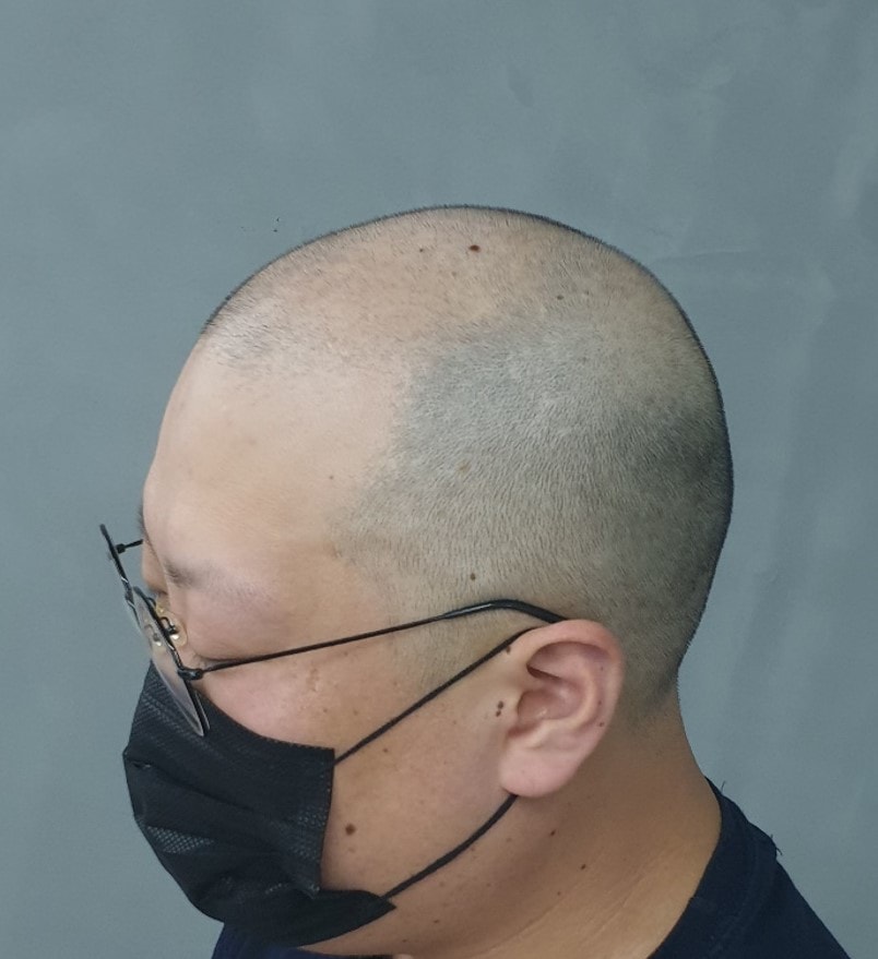 두피문신 받기전 옆모습