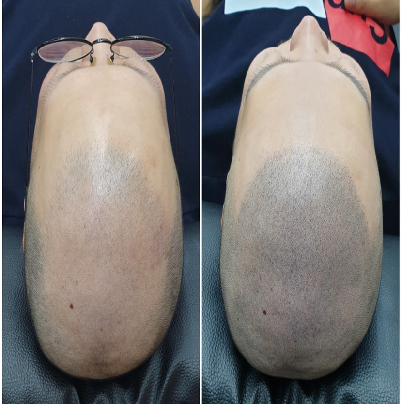 두피문신 받기 전/후 중간단계 비교 사진.