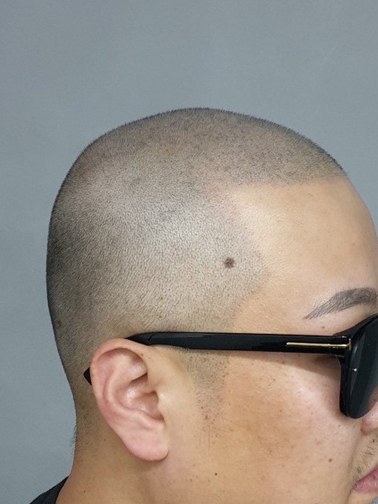 두피문신 완료 사진.자연스러움..