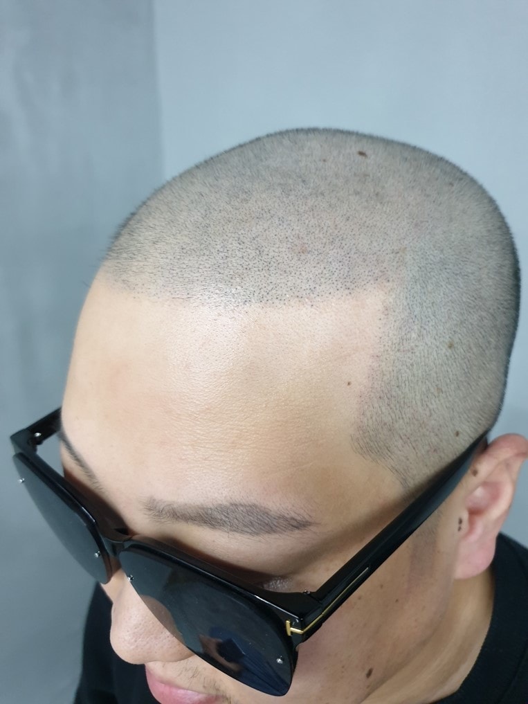 두피문신 완료 사진. 젊어짐.