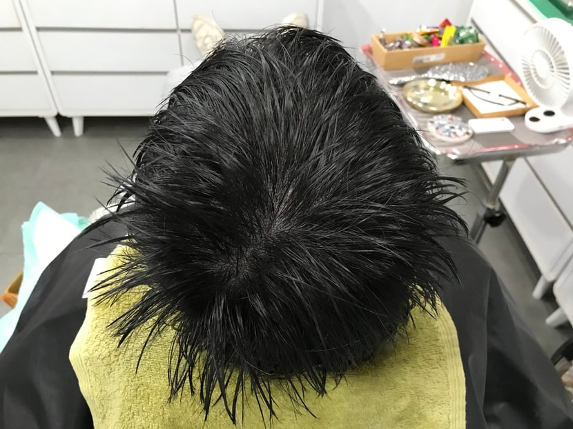 시술직후