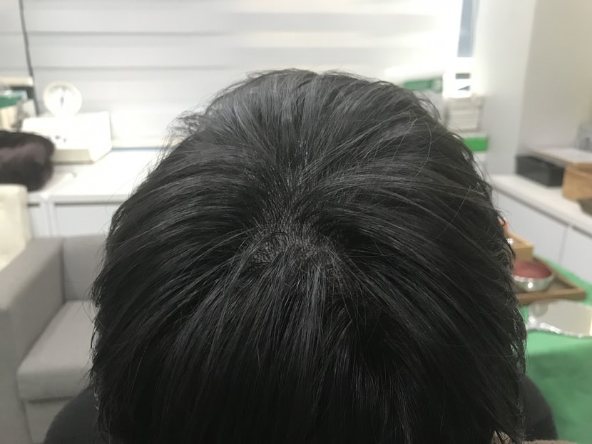 시술끝나고 드라이후 사진이에요