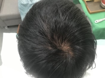 시술전 평상시 상태입니다