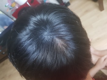 7/7 각질모이기 전 사진입니다.