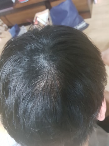 7/11 각질이 많이일어나고 떨어지고 있음을 알수있어요