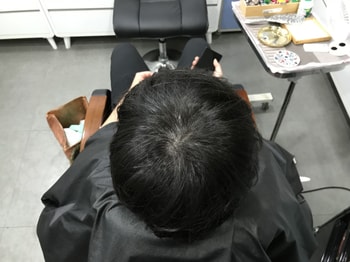시술 후