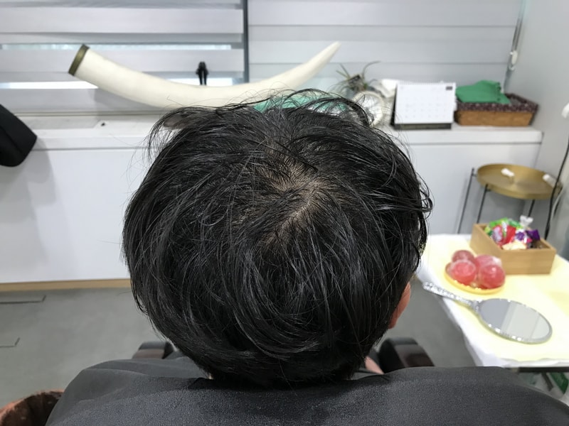 수지침 미세도트 1차 후기