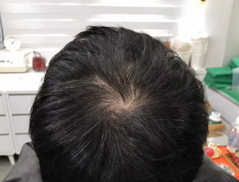 [연세미다인] 정수리 두피문신 5년 후기