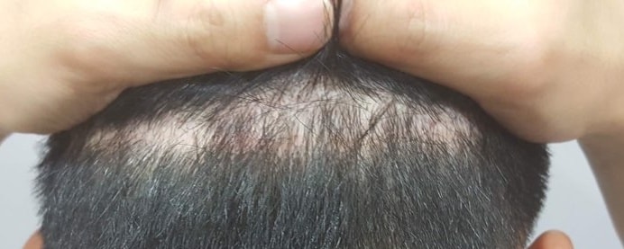在米开朗基罗医院接受了喉部切开疤痕、头顶、眉毛、络腮胡子护理。