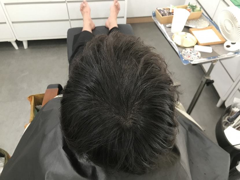 시술 후