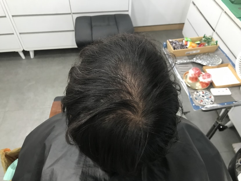 시술 전