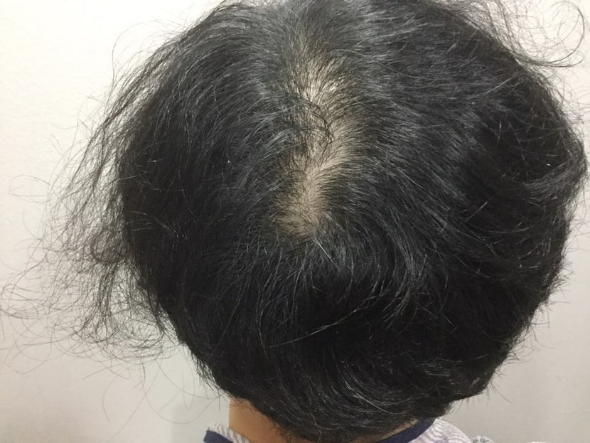 1달 전 시술 전
