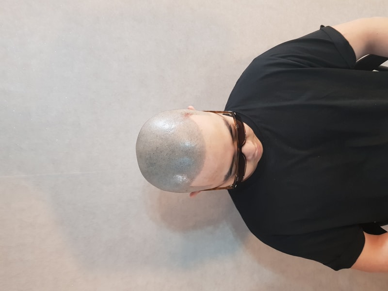 두피문신 5차까지 마무리 햇습니다.