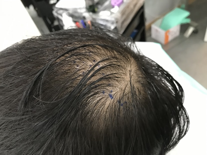 시술전