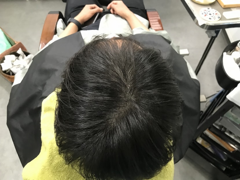 2차 시술 후
