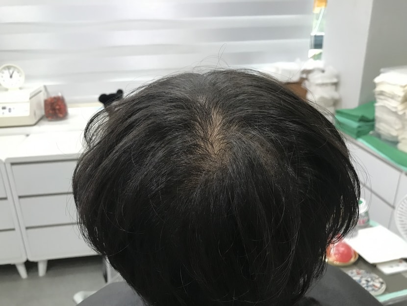 시술 전