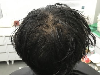 시술 전 젖은머리