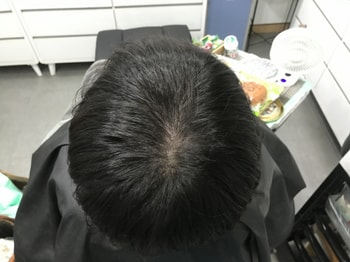 1차 시술 후