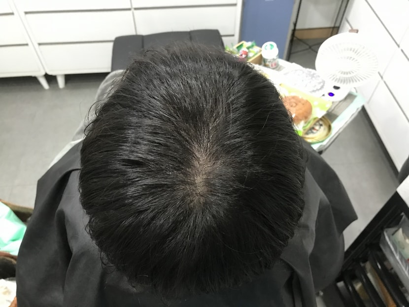 1차 시술 후