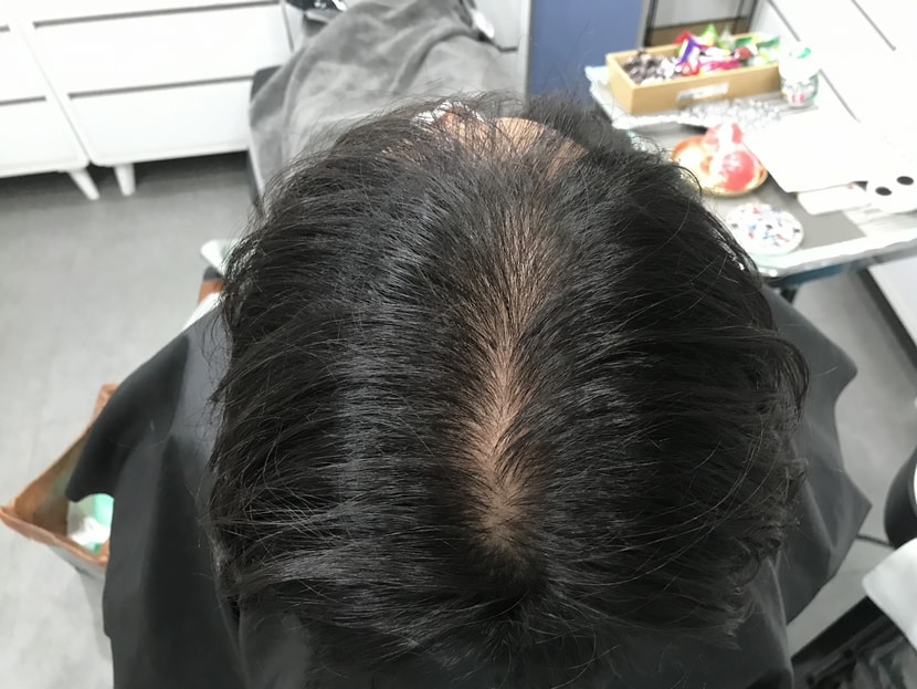 시술 전
