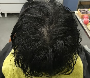 2차 시술 후 젖은머리