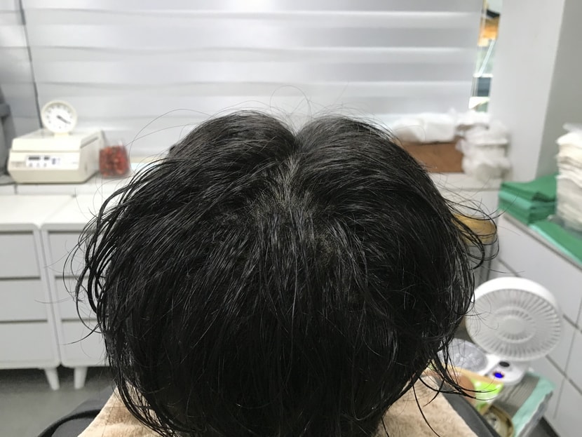 1차 시술 후 젖은머리