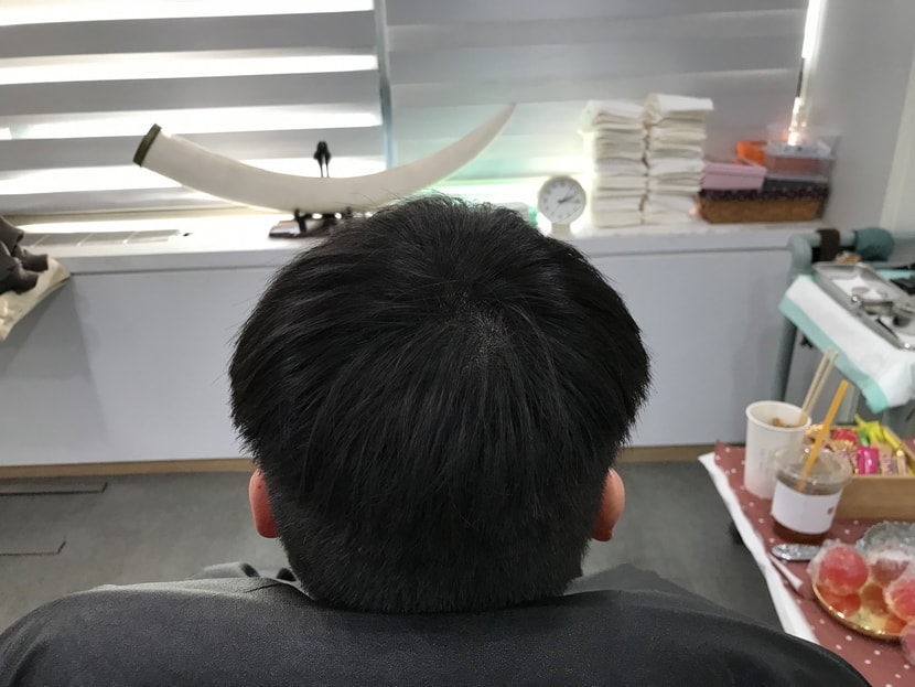 두피문신 시술 후 상태입니다
