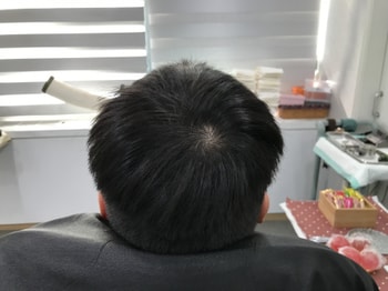 두피문신 시술 전 상태입니다!