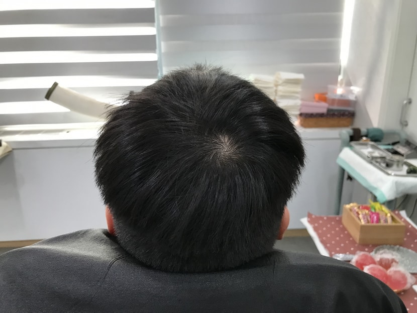 두피문신 시술 전 상태입니다!