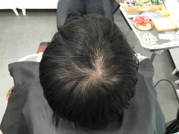 시술 전