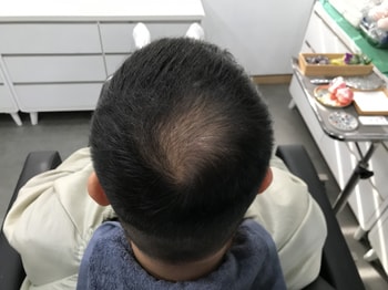 시술전(안젖은머리2)