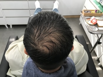 시술전(젖은머리2)