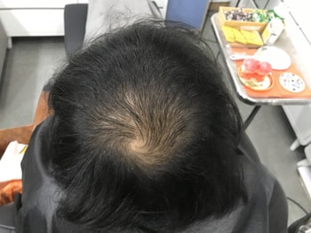 시술 전