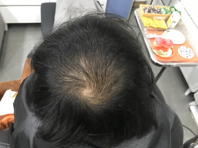 시술 전