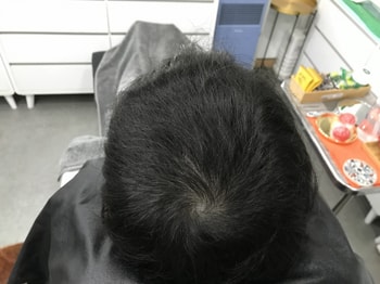 시술 후, 리터치 전