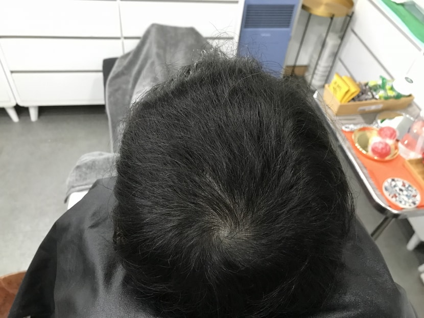 시술 후, 리터치 전