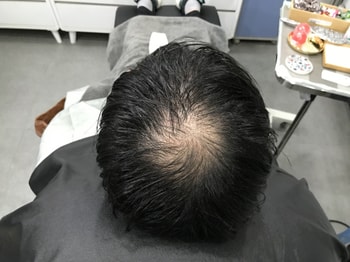 시술전 머리