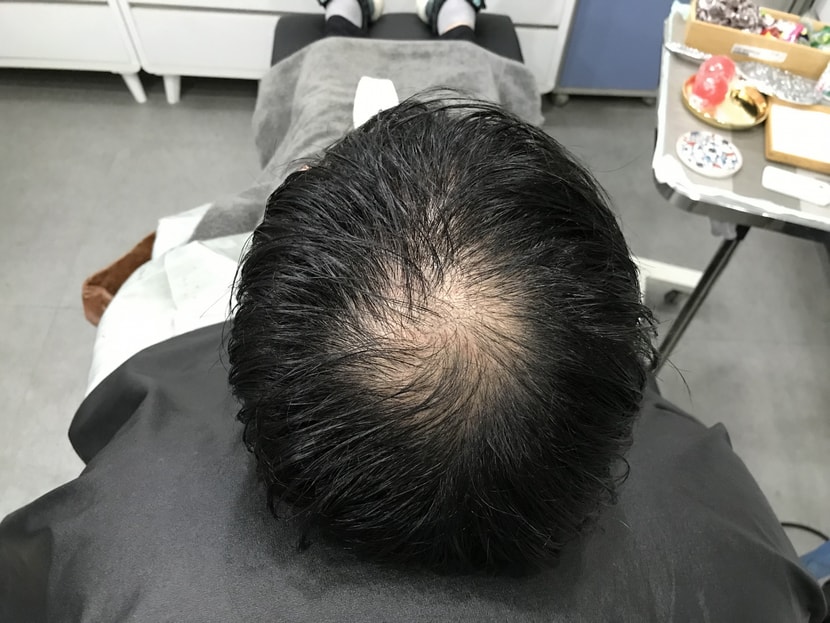시술전 머리