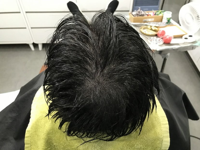 시술후 머리