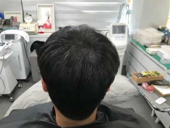 &lt;시술후&gt;