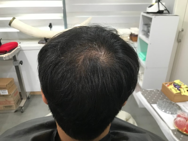 头皮纹身后期