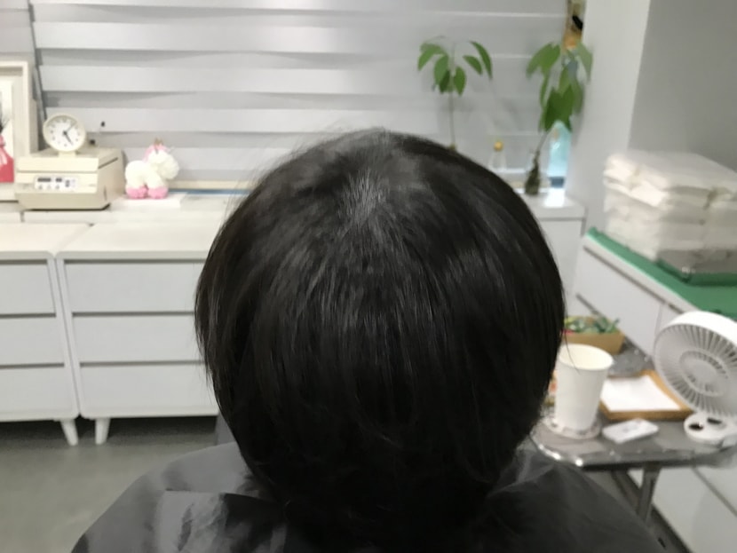 두피문신 후(마른 상태)