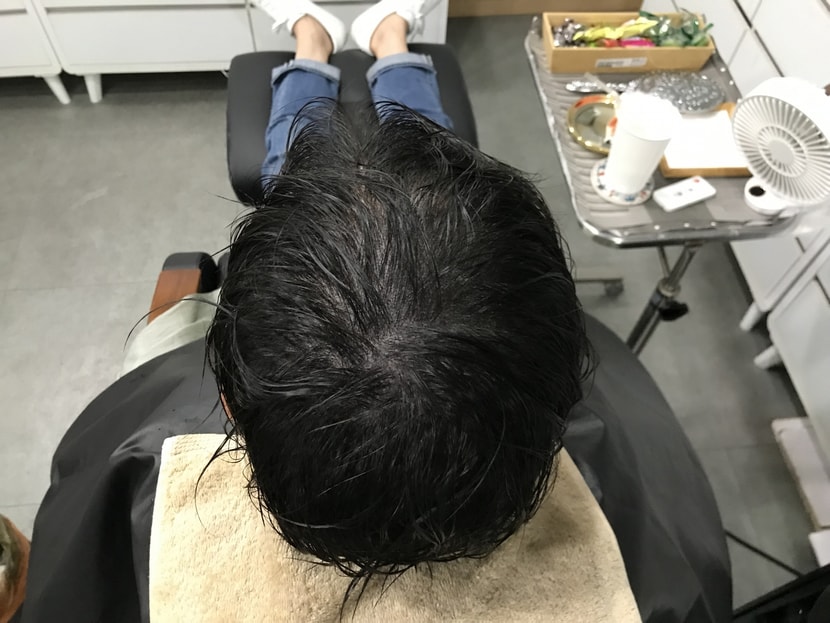 두피문신 후(젖은 상태)