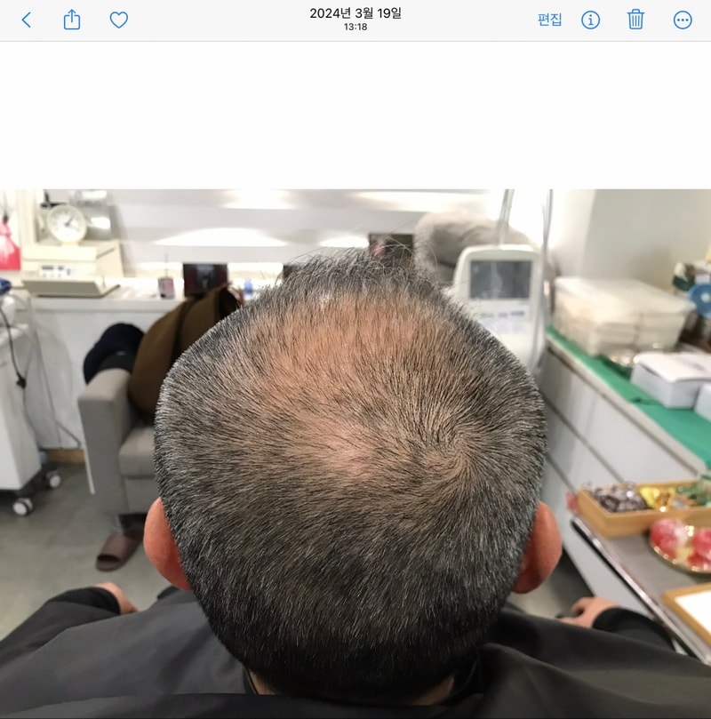 전체두피문신 1년 후기