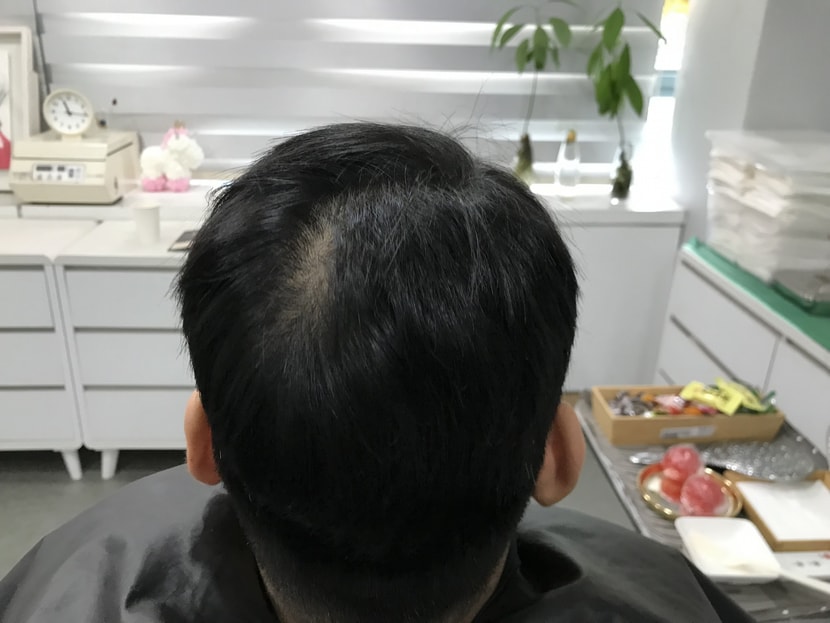 두피문신 전