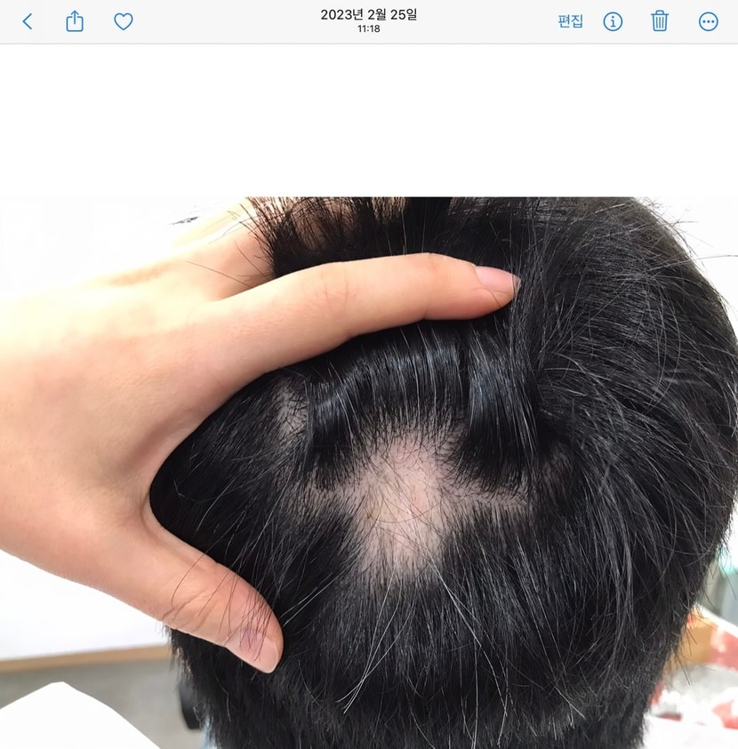 &lt;원형 탈모 치료 전&gt;