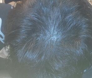 脱发遮瑕术后期