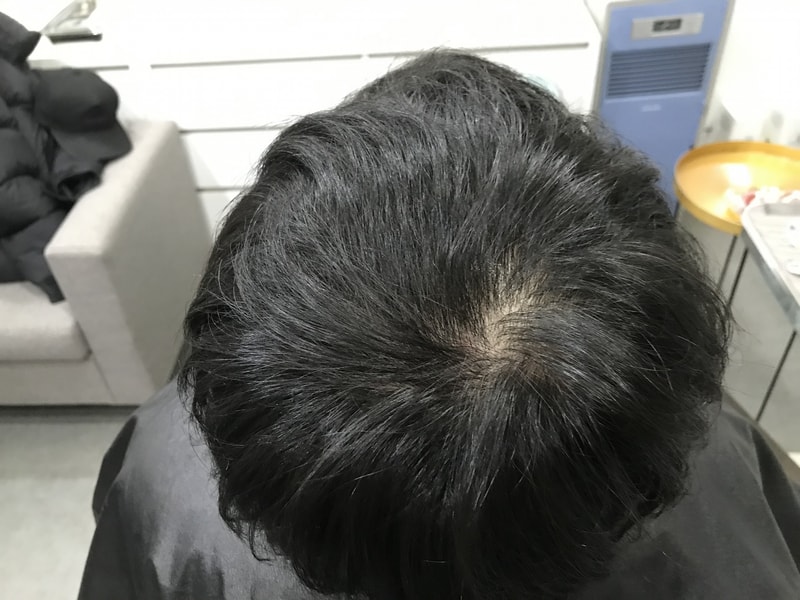 정수리 소갈머리 두피문신