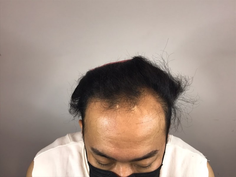 头皮纹身（半永久）1次手术后记 ^^