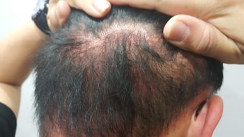 타병원 절개수술상처 색소요법 시술 후